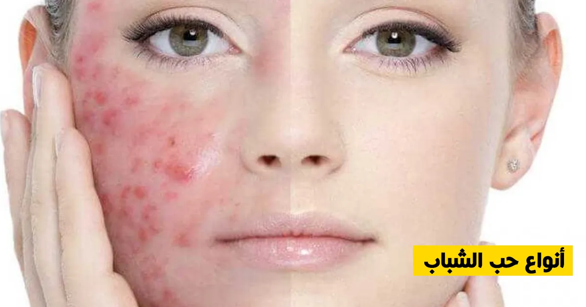 أنواع حب الشباب